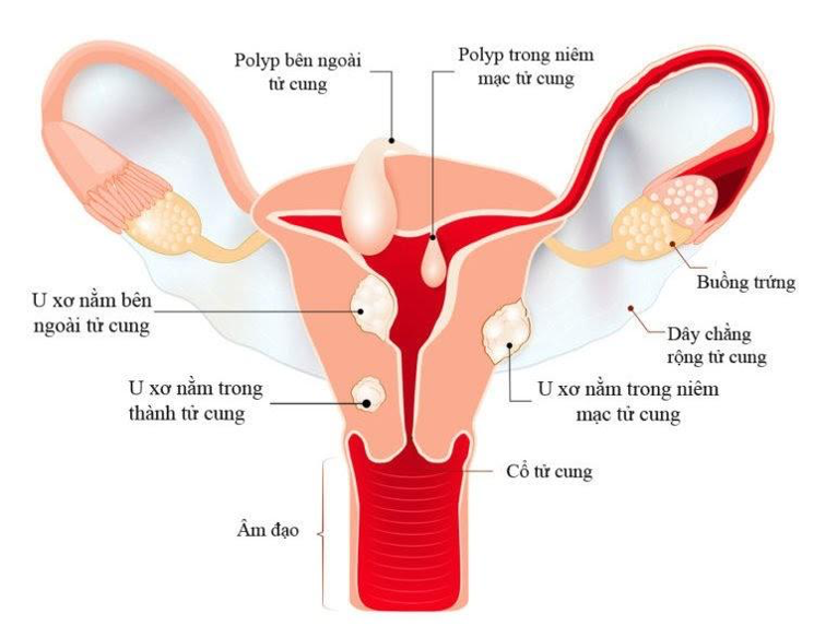 Ảnh hưởng nguy hiểm của u xơ tử cung tới việc thụ thai